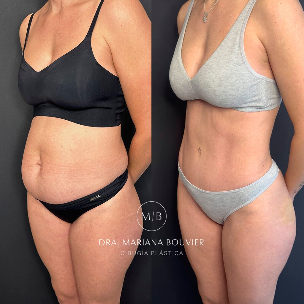 Antes y después — Abdominoplastia
