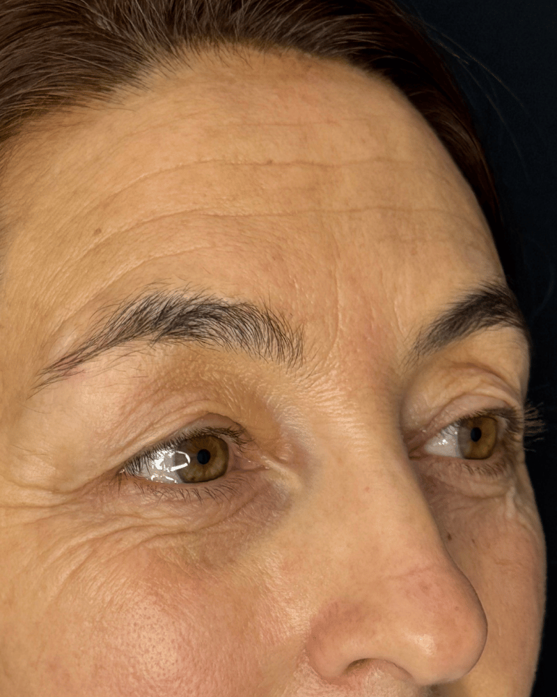 Antes — Blefaroplastia