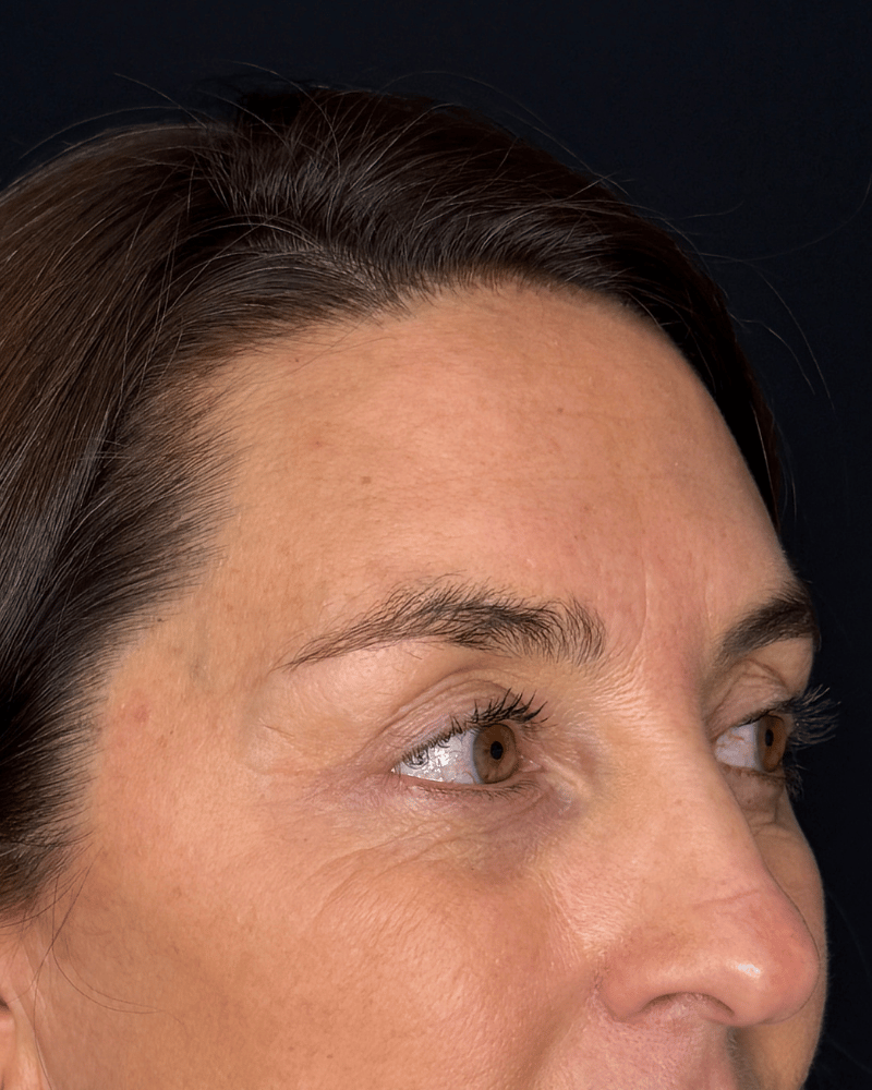 Después — Blefaroplastia