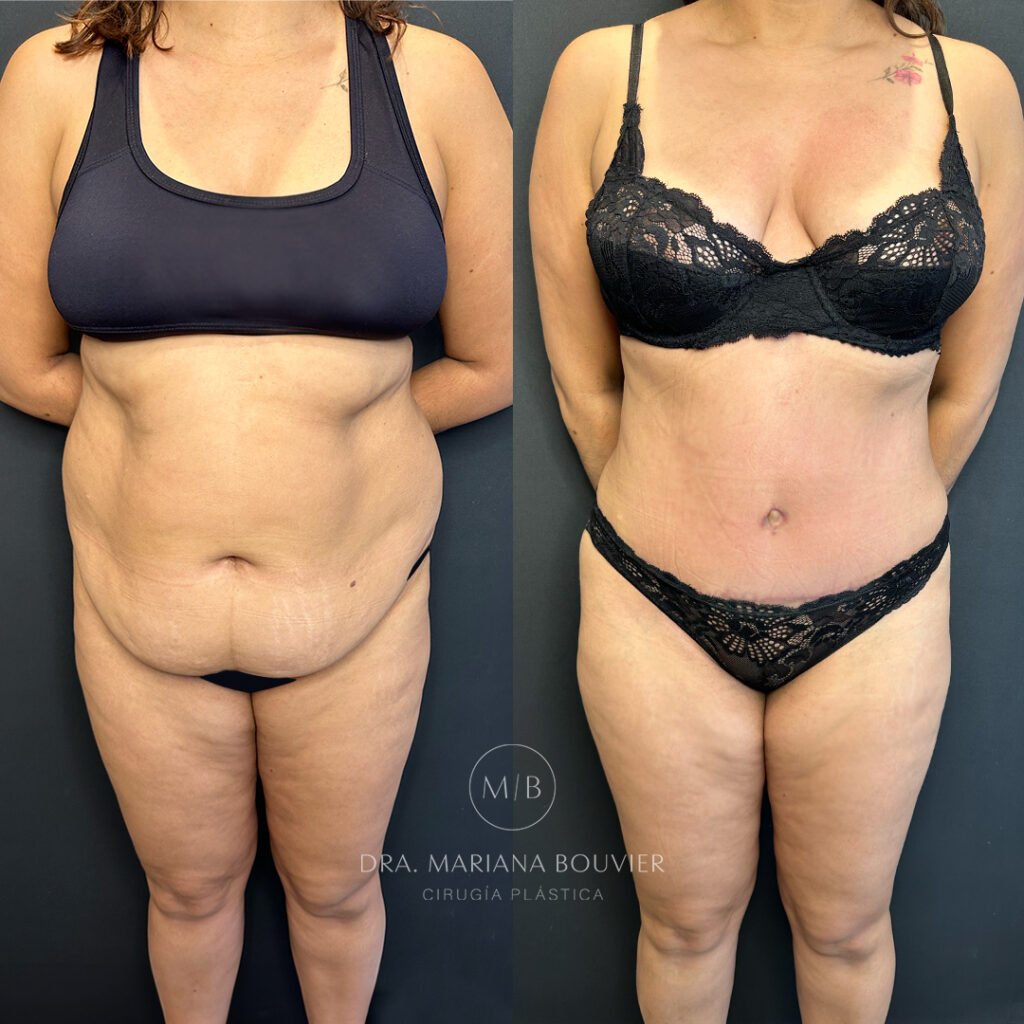 Antes y después — Abdominoplastia