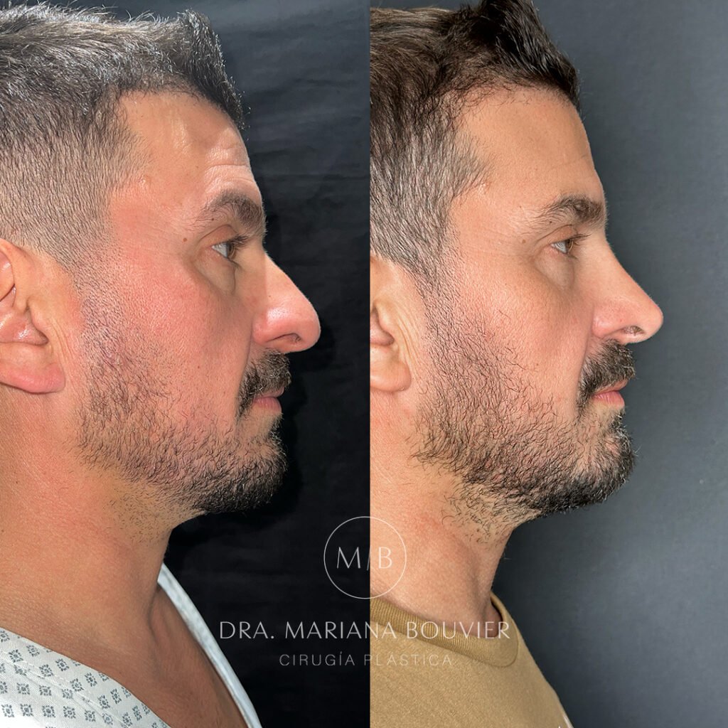 Antes — Rinoplastia