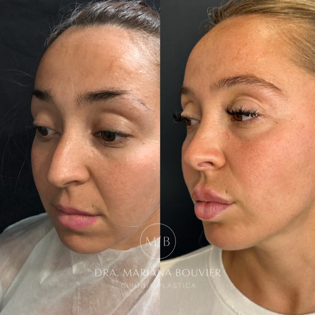 Después — Rinoplastia